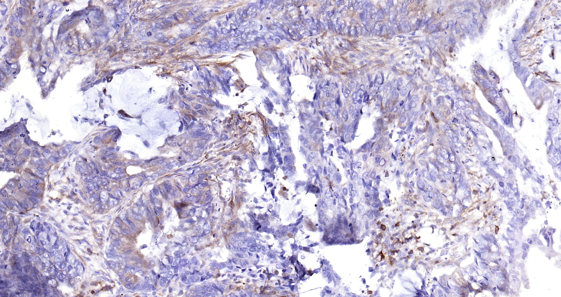 Paraformaldehyde-fixed, paraffin embedded Human colon cancer; Antigen retrieval by boiling in sodium citrate buffer (pH6.0) for 15min; Block endogenous peroxidase by 3% hydrogen peroxide for 20 minutes; Blocking buffer (normal goat serum) at 37°C for 30min; Antibody incubation with Glycogen synthase 1(S641) (10C1) Monoclonal Antibody, Unconjugated (bsm-52159R) at 1:200 overnight at 4°C, DAB staining.