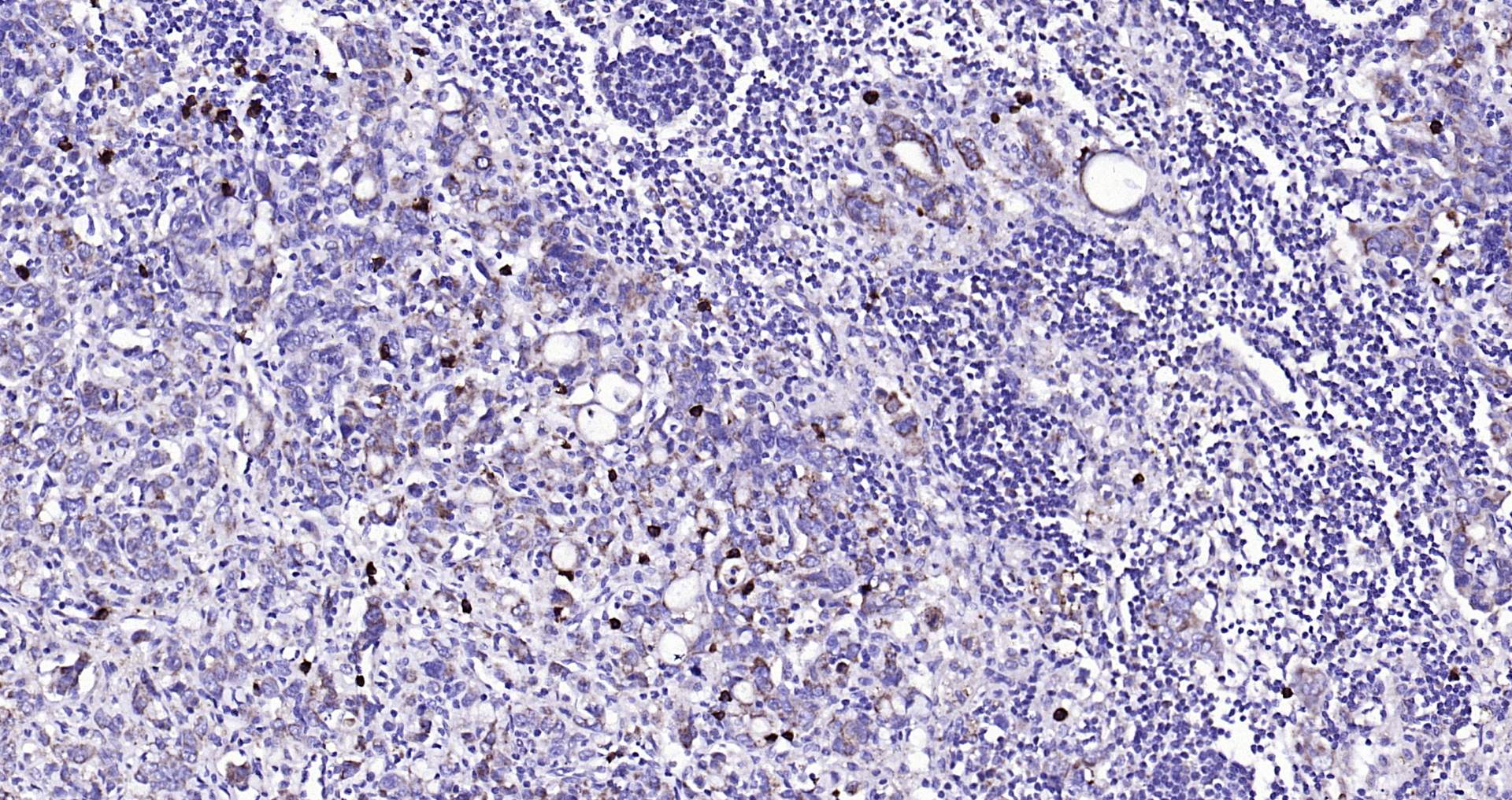 Paraformaldehyde-fixed, paraffin embedded Human gastric carcinoma; Antigen retrieval by boiling in sodium citrate buffer (pH6.0) for 15min; Block endogenous peroxidase by 3% hydrogen peroxide for 20 minutes; Blocking buffer (normal goat serum) at 37°C for 30min; Antibody incubation with CD134 Polyclonal Antibody, Unconjugated (bs-2685R) at 1:200 overnight at 4°C, DAB staining.