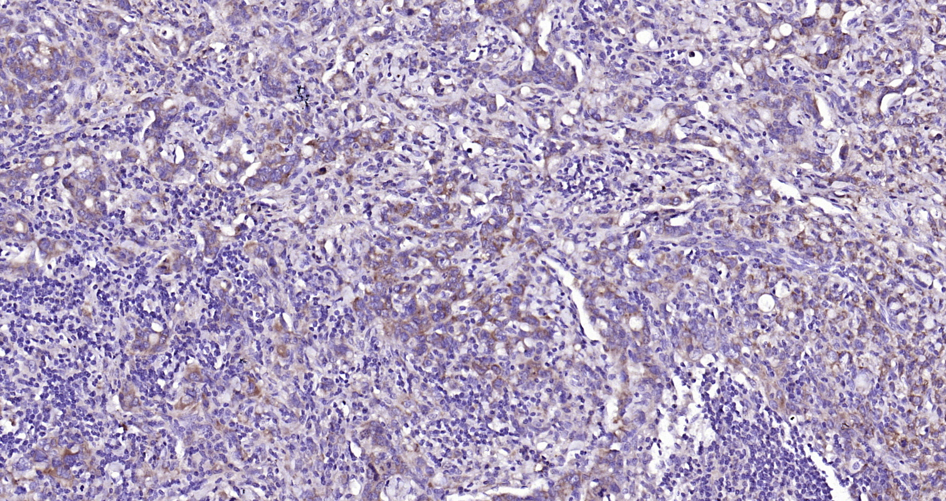 Paraformaldehyde-fixed, paraffin embedded Human gastric carcinoma; Antigen retrieval by boiling in sodium citrate buffer (pH6.0) for 15min; Block endogenous peroxidase by 3% hydrogen peroxide for 20 minutes; Blocking buffer (normal goat serum) at 37°C for 30min; Antibody incubation with CLEC5A Polyclonal Antibody, Unconjugated (bs-2663R) at 1:200 overnight at 4°C, DAB staining.