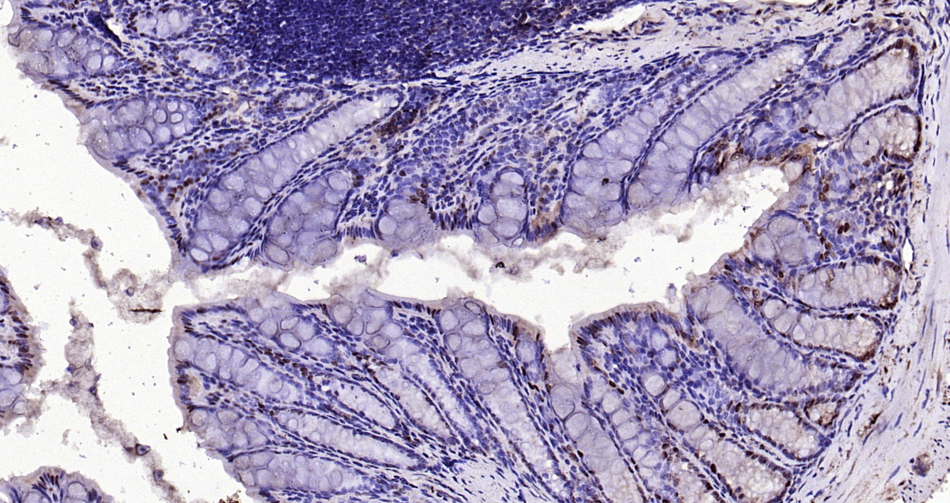 Paraformaldehyde-fixed, paraffin embedded Mouse colon; Antigen retrieval by boiling in sodium citrate buffer (pH6.0) for 15min; Block endogenous peroxidase by 3% hydrogen peroxide for 20 minutes; Blocking buffer (normal goat serum) at 37°C for 30min; Antibody incubation with IL-33 Polyclonal Antibody, Unconjugated (bs-2633R) at 1:200 overnight at 4°C, DAB staining.