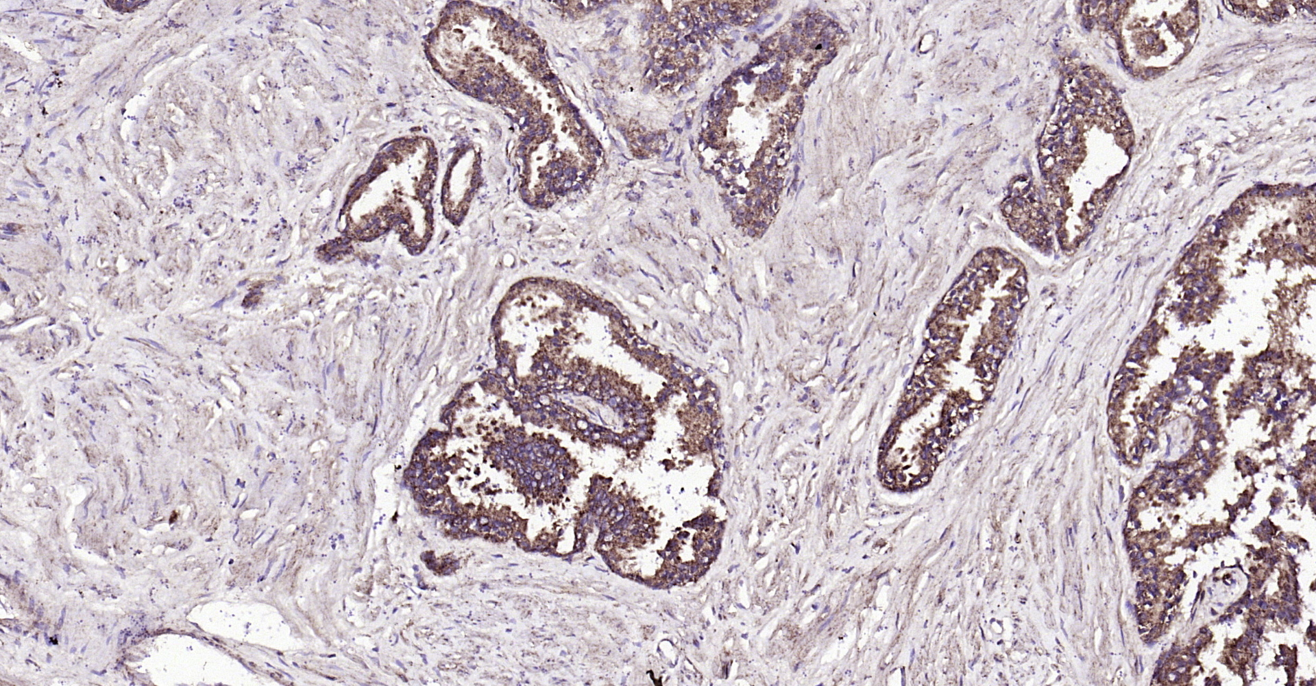 Paraformaldehyde-fixed, paraffin embedded Human prostate; Antigen retrieval by boiling in sodium citrate buffer (pH6.0) for 15min; Block endogenous peroxidase by 3% hydrogen peroxide for 20 minutes; Blocking buffer (normal goat serum) at 37°C for 30min; Antibody incubation with FGF8 Polyclonal Antibody, Unconjugated (bs-0735R) at 1:200 overnight at 4°C, DAB staining.