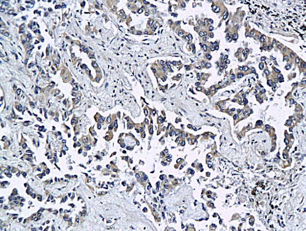 Formalin-fixed and paraffin embedded rat differentiated adenocarcinoma labeled with Anti ESAM Polyclonal Antibody, Unconjugated (bs-5838R) at 1:200 followed by conjugation to the secondary antibody and DAB staining