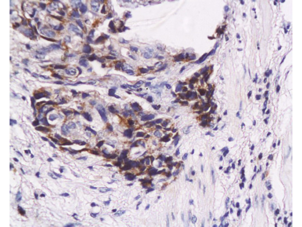Formalin-fixed and paraffin embedded human esophageal carcinoma labeled with Anti-WIG-1/PAG608 Polyclonal Antibody, Unconjugated (bs-0942R) at 1:200, followed by conjugation to the secondary antibody and DAB staining
