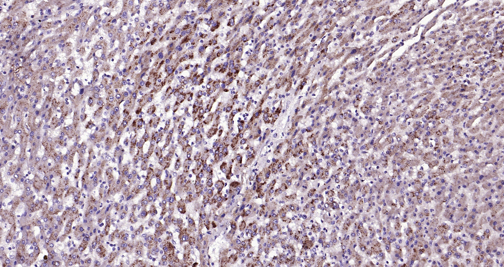 Paraformaldehyde-fixed, paraffin embedded Human liver; Antigen retrieval by boiling in sodium citrate buffer (pH6.0) for 15min; Block endogenous peroxidase by 3% hydrogen peroxide for 20 minutes; Blocking buffer (normal goat serum) at 37°C for 30min; Antibody incubation with LAMP2 Polyclonal Antibody, Unconjugated (bs-2379R) at 1:200 overnight at 4°C, DAB staining.