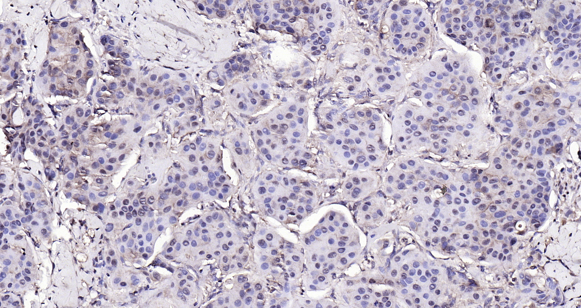 Paraformaldehyde-fixed, paraffin embedded Human breast cancer; Antigen retrieval by boiling in sodium citrate buffer (pH6.0) for 15min; Block endogenous peroxidase by 3% hydrogen peroxide for 20 minutes; Blocking buffer (normal goat serum) at 37°C for 30min; Antibody incubation with Pyk2 (Tyr402) Polyclonal Antibody, Unconjugated (bs-3400R) at 1:200 overnight at 4°C, DAB staining.
