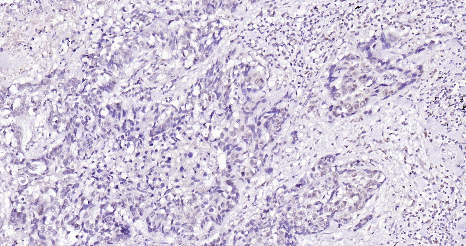 Paraformaldehyde-fixed, paraffin embedded Human lung cancer; Antigen retrieval by boiling in sodium citrate buffer (pH6.0) for 15min; Block endogenous peroxidase by 3% hydrogen peroxide for 20 minutes; Blocking buffer (normal goat serum) at 37°C for 30min; Antibody incubation with LATS1/2 Polyclonal Antibody, Unconjugated (bs-4081R) at 1:200 overnight at 4°C, DAB staining.