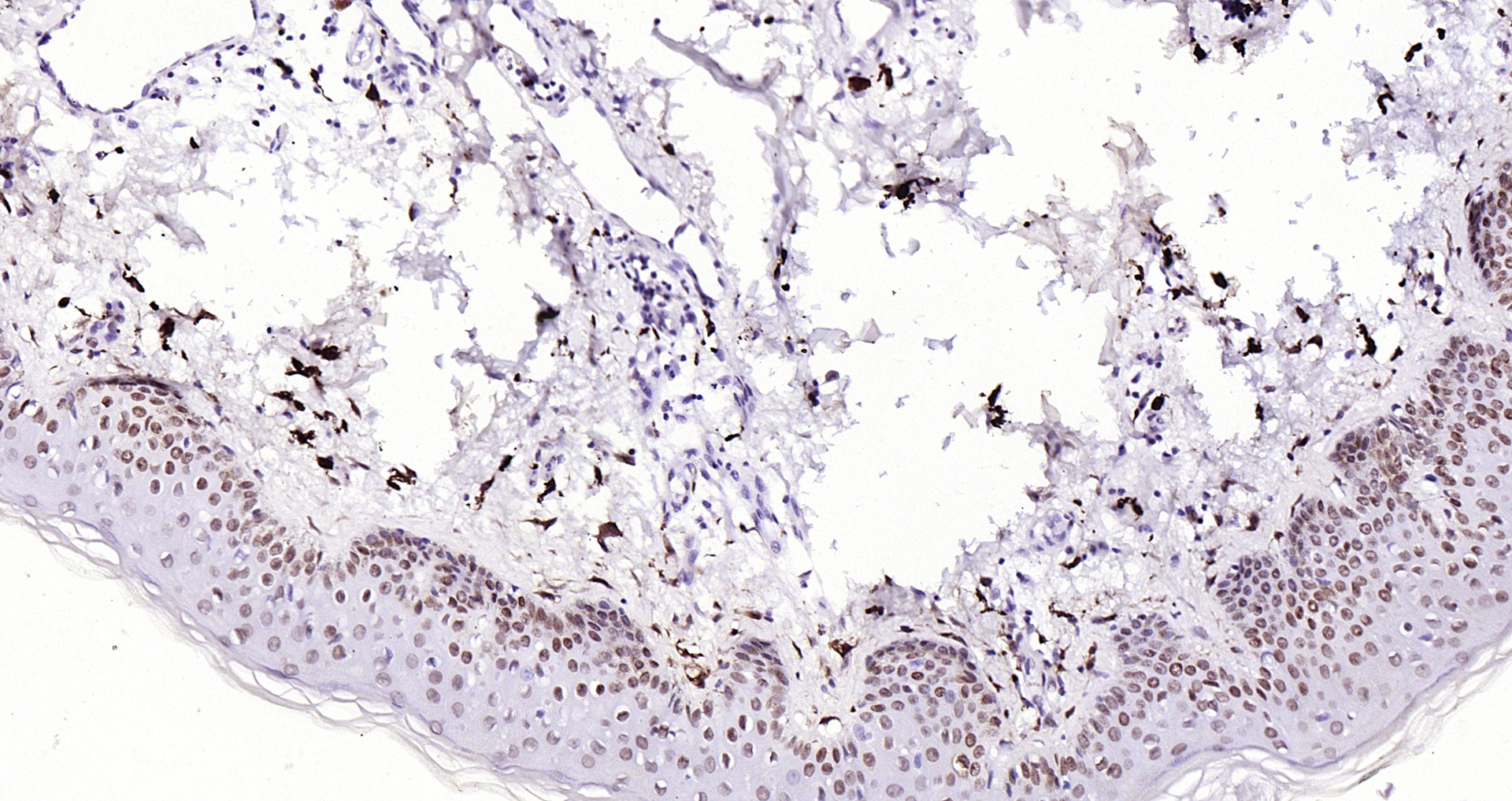 Paraformaldehyde-fixed, paraffin embedded Human skin cancer; Antigen retrieval by boiling in sodium citrate buffer (pH6.0) for 15min; Block endogenous peroxidase by 3% hydrogen peroxide for 20 minutes; Blocking buffer (normal goat serum) at 37°C for 30min; Antibody incubation with H2AFX (8C5) Monoclonal Antibody, Unconjugated (bsm-51222M) at 1:200 overnight at 4°C, DAB staining.
