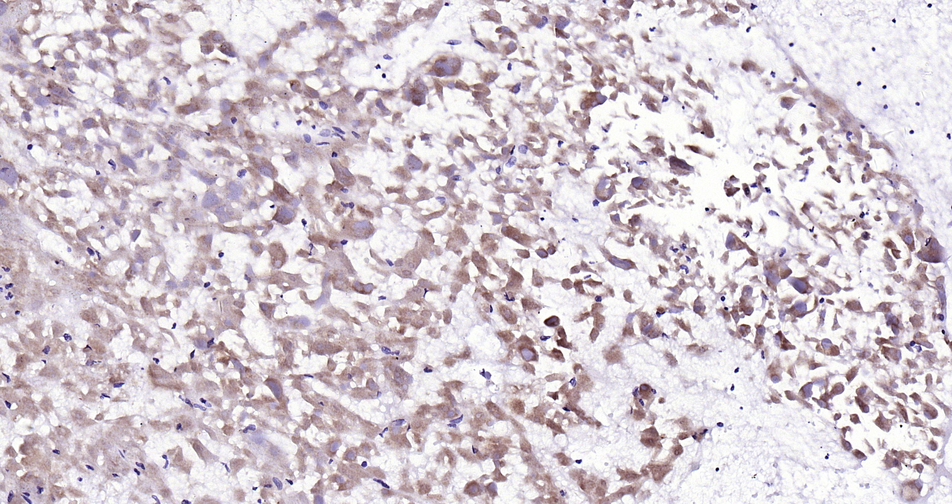 Paraformaldehyde-fixed, paraffin embedded Human liver cancer; Antigen retrieval by boiling in sodium citrate buffer (pH6.0) for 15min; Block endogenous peroxidase by 3% hydrogen peroxide for 20 minutes; Blocking buffer (normal goat serum) at 37°C for 30min; Antibody incubation with Galectin 8 (1A4) Monoclonal Antibody, Unconjugated (bsm-54301R) at 1:200 overnight at 4°C, DAB staining.