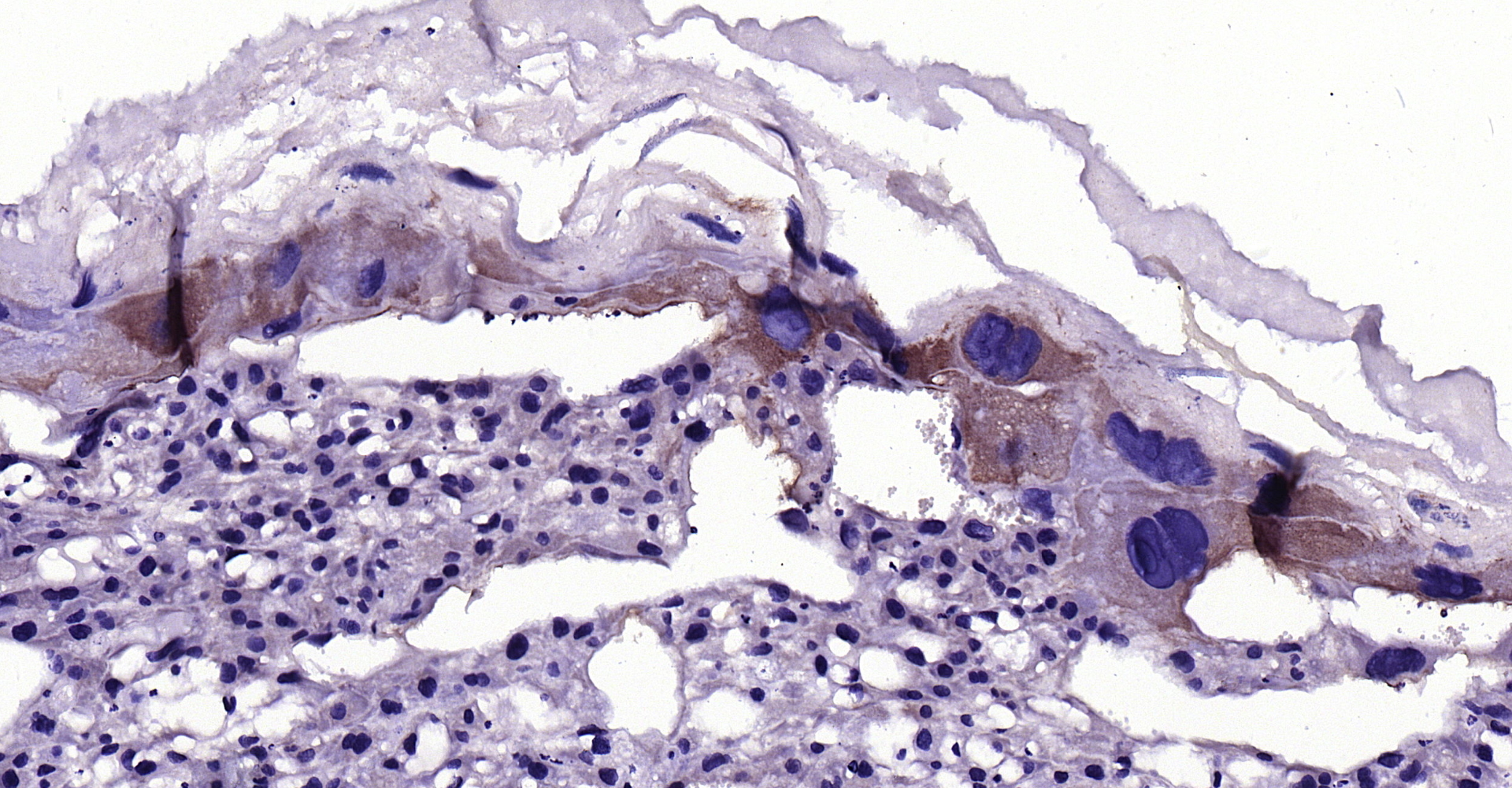 Paraformaldehyde-fixed, paraffin embedded Rat placenta; Antigen retrieval by boiling in sodium citrate buffer (pH6.0) for 15min; Block endogenous peroxidase by 3% hydrogen peroxide for 20 minutes; Blocking buffer (normal goat serum) at 37°C for 30min; Antibody incubation with LIFR/CD118 Polyclonal Antibody, Unconjugated (bs-1458R) at 1:200 overnight at 4°C, DAB staining. Paraformaldehyde-fixed, paraffin embedded Rat placenta; Antigen retrieval by boiling in sodium citrate buffer (pH6.0) for 15min; Block endogenous peroxidase by 3% hydrogen peroxide for 20 minutes; Blocking buffer (normal goat serum) at 37°C for 30min; Antibody incubation with LIFR/CD118 Polyclonal Antibody, Unconjugated (bs-1458R) at 1:200 overnight at 4°C, DAB staining.