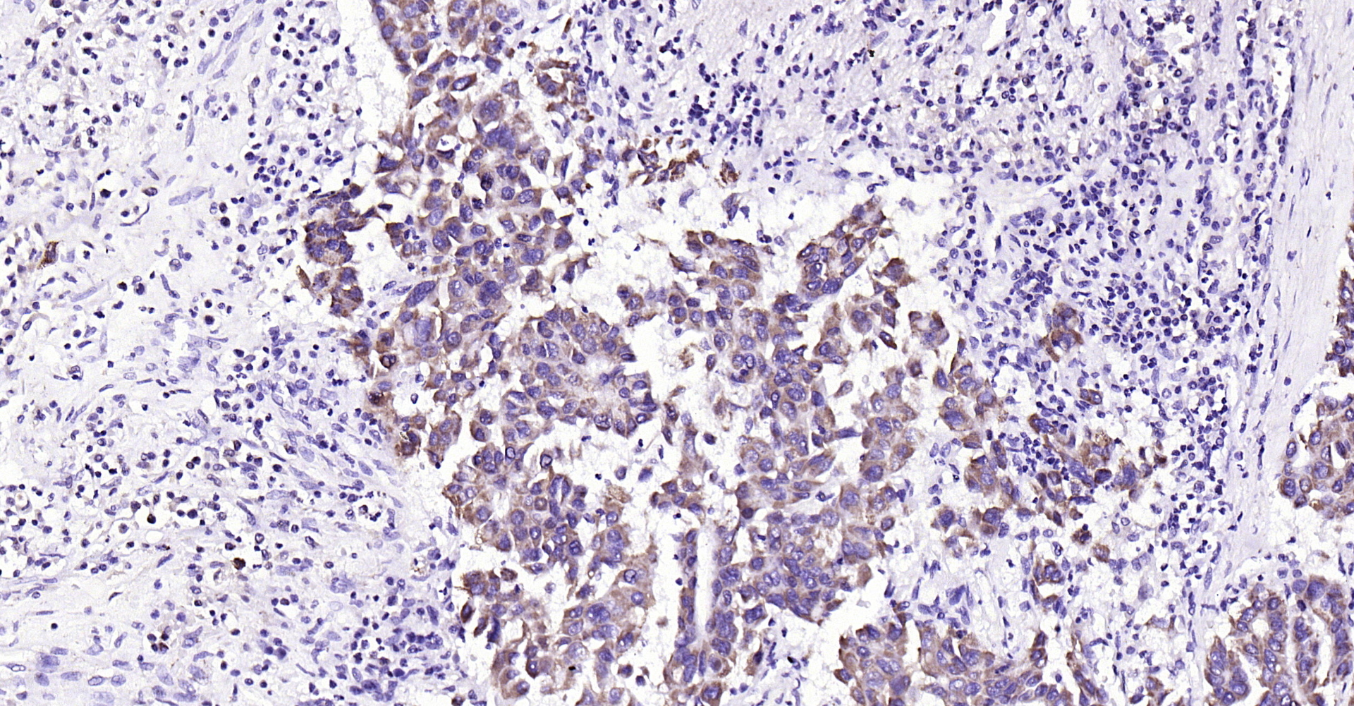 Paraformaldehyde-fixed, paraffin embedded Human liver cancer; Antigen retrieval by boiling in sodium citrate buffer (pH6.0) for 15min; Block endogenous peroxidase by 3% hydrogen peroxide for 20 minutes; Blocking buffer (normal goat serum) at 37°C for 30min; Antibody incubation with ADM2 Polyclonal Antibody, Unconjugated (bs-2985R) at 1:200 overnight at 4°C, DAB staining.