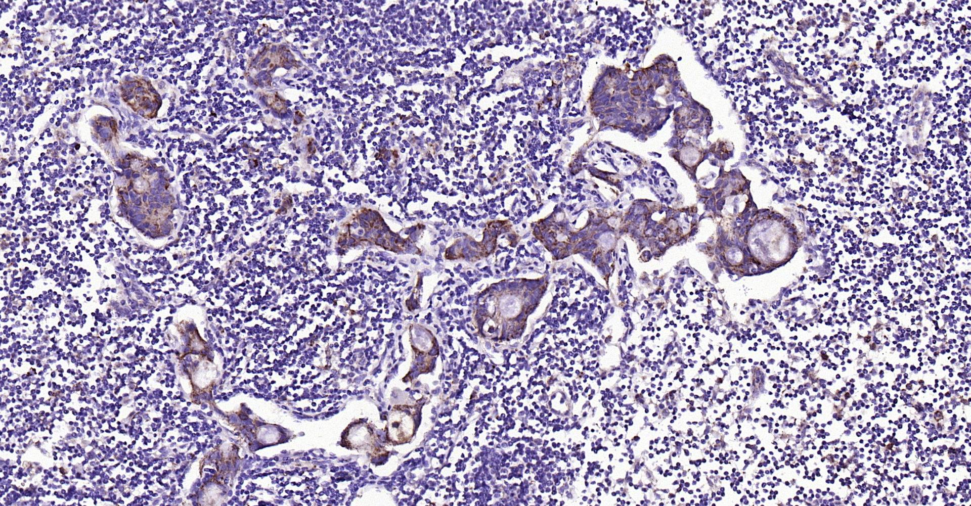 Paraformaldehyde-fixed, paraffin embedded Human gastric carcinoma; Antigen retrieval by boiling in sodium citrate buffer (pH6.0) for 15min; Block endogenous peroxidase by 3% hydrogen peroxide for 20 minutes; Blocking buffer (normal goat serum) at 37°C for 30min; Antibody incubation with ADM2 Polyclonal Antibody, Unconjugated (bs-2985R) at 1:200 overnight at 4°C, DAB staining.