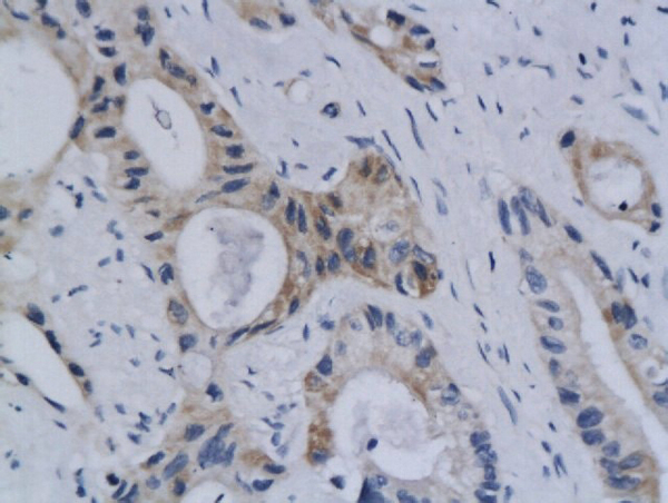 Formalin-fixed and paraffin embedded human colon labeled with Anti Styk1 Polyclonal Antibody, Unconjugated (bs-5957R) followed by conjugation to the secondary antibody and DAB staining