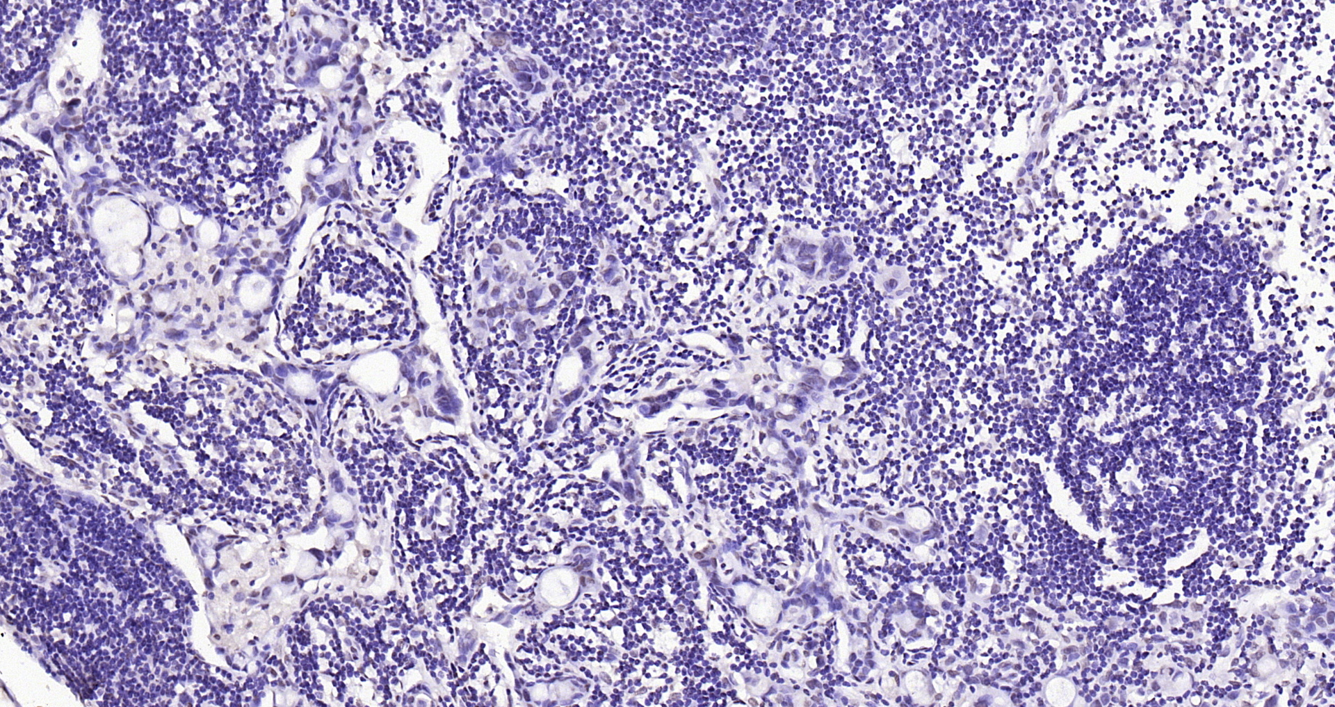Paraformaldehyde-fixed, paraffin embedded (human gastric carcinoma); Antigen retrieval by boiling in sodium citrate buffer (pH6.0) for 15min; Block endogenous peroxidase by 3% hydrogen peroxide for 20 minutes; Blocking buffer (normal goat serum) at 37°C for 30min; Antibody incubation with (SOX9) Polyclonal Antibody, Unconjugated (bs-10725R) at 1:200 overnight at 4°C, followed by operating according to SP Kit(Rabbit) (sp-0023) instructionsand DAB staining.