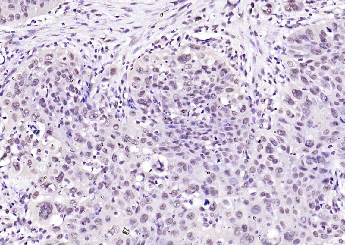 Paraformaldehyde-fixed, paraffin embedded (human laryngeal carcinoma); Antigen retrieval by boiling in sodium citrate buffer (pH6.0) for 15min; Block endogenous peroxidase by 3% hydrogen peroxide for 20 minutes; Blocking buffer (normal goat serum) at 37°C for 30min; Antibody incubation with (SOX9) Polyclonal Antibody, Unconjugated (bs-4177R) at 1:200 overnight at 4°C, followed by operating according to SP Kit(Rabbit) (sp-0023) instructionsand DAB staining.