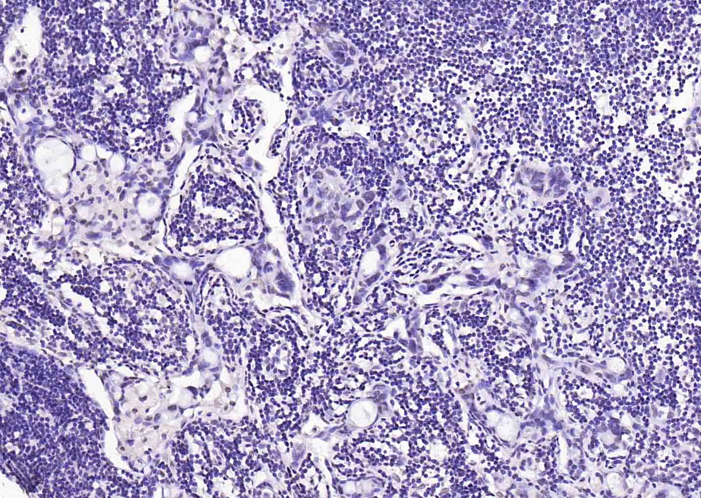 Paraformaldehyde-fixed, paraffin embedded (human gastric carcinoma); Antigen retrieval by boiling in sodium citrate buffer (pH6.0) for 15min; Block endogenous peroxidase by 3% hydrogen peroxide for 20 minutes; Blocking buffer (normal goat serum) at 37°C for 30min; Antibody incubation with (SOX9) Polyclonal Antibody, Unconjugated (bs-4177R) at 1:200 overnight at 4°C, followed by operating according to SP Kit(Rabbit) (sp-0023) instructionsand DAB staining.