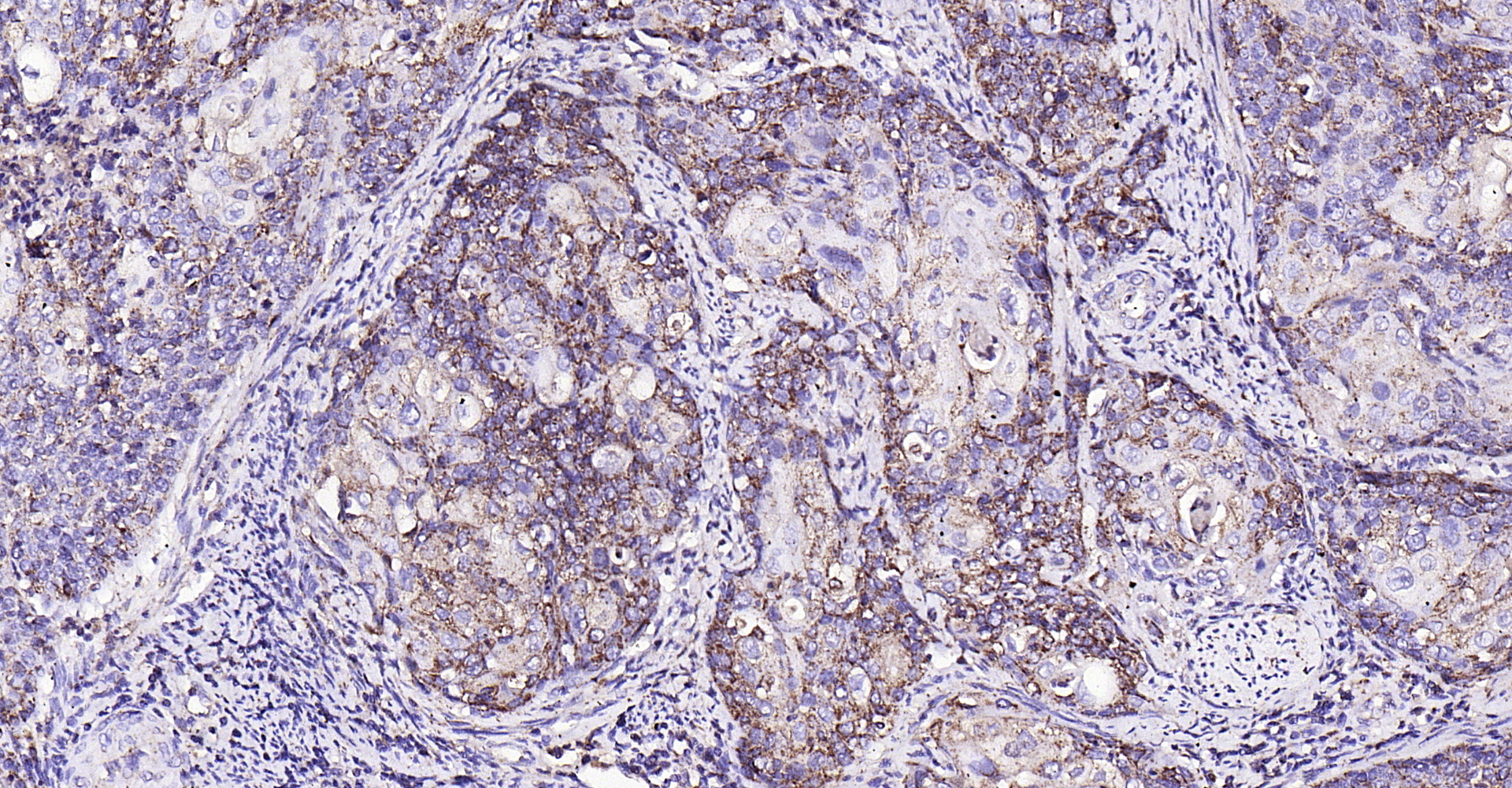Paraformaldehyde-fixed, paraffin embedded (human cervical carcinoma); Antigen retrieval by boiling in sodium citrate buffer (pH6.0) for 15min; Block endogenous peroxidase by 3% hydrogen peroxide for 20 minutes; Blocking buffer (normal goat serum) at 37°C for 30min; Antibody incubation with (MMP-1) Polyclonal Antibody, Unconjugated (bs-4597R) at 1:200 overnight at 4°C, followed by operating according to SP Kit(Rabbit) (sp-0023) instructionsand DAB staining.