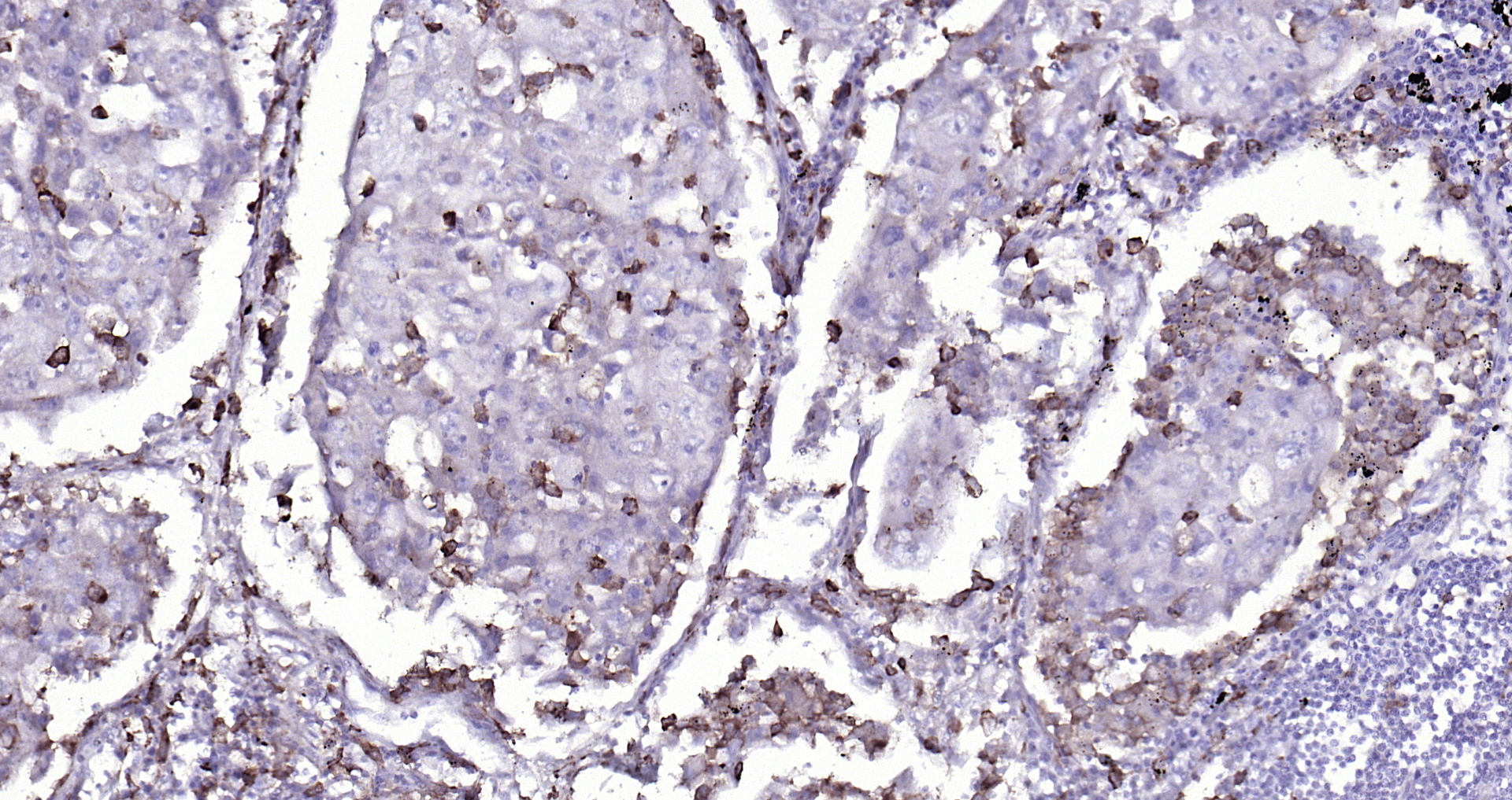 Paraformaldehyde-fixed, paraffin embedded (human lung carcinoma); Antigen retrieval by boiling in sodium citrate buffer (pH6.0) for 15min; Block endogenous peroxidase by 3% hydrogen peroxide for 20 minutes; Blocking buffer (normal goat serum) at 37°C for 30min; Antibody incubation with (CD14) Polyclonal Antibody, Unconjugated (bs-1192R) at 1:200 overnight at 4°C, followed by operating according to SP Kit(Rabbit) (sp-0023) instructionsand DAB staining. Paraformaldehyde-fixed, paraffin embedded (human lung carcinoma); Antigen retrieval by boiling in sodium citrate buffer (pH6.0) for 15min; Block endogenous peroxidase by 3% hydrogen peroxide for 20 minutes; Blocking buffer (normal goat serum) at 37°C for 30min; Antibody incubation with (CD14) Polyclonal Antibody, Unconjugated (bs-1192R) at 1:200 overnight at 4°C, followed by operating according to SP Kit(Rabbit) (sp-0023) instructionsand DAB staining.