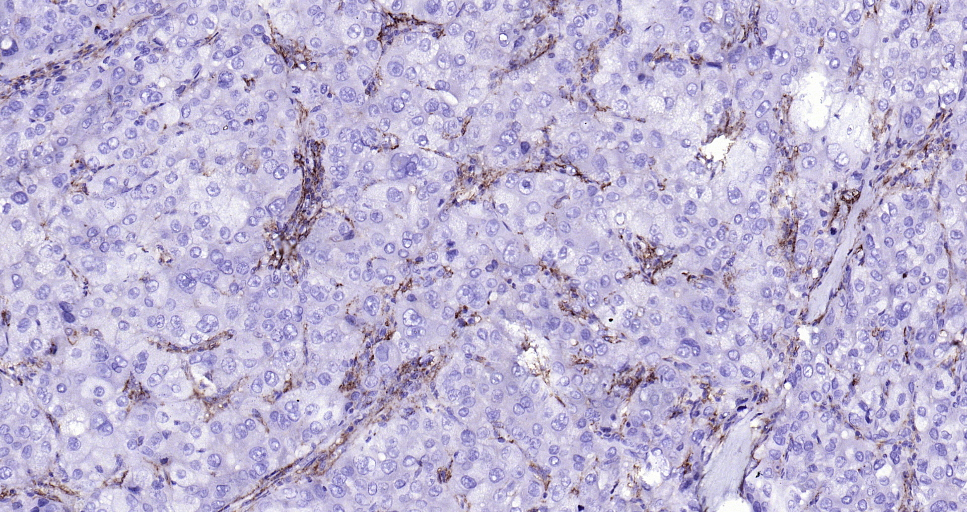 Paraformaldehyde-fixed, paraffin embedded (human liver carcinoma); Antigen retrieval by boiling in sodium citrate buffer (pH6.0) for 15min; Block endogenous peroxidase by 3% hydrogen peroxide for 20 minutes; Blocking buffer (normal goat serum) at 37°C for 30min; Antibody incubation with (CD14) Polyclonal Antibody, Unconjugated (bs-1192R) at 1:200 overnight at 4°C, followed by operating according to SP Kit(Rabbit) (sp-0023) instructionsand DAB staining. Paraformaldehyde-fixed, paraffin embedded (human liver carcinoma); Antigen retrieval by boiling in sodium citrate buffer (pH6.0) for 15min; Block endogenous peroxidase by 3% hydrogen peroxide for 20 minutes; Blocking buffer (normal goat serum) at 37°C for 30min; Antibody incubation with (CD14) Polyclonal Antibody, Unconjugated (bs-1192R) at 1:200 overnight at 4°C, followed by operating according to SP Kit(Rabbit) (sp-0023) instructionsand DAB staining.