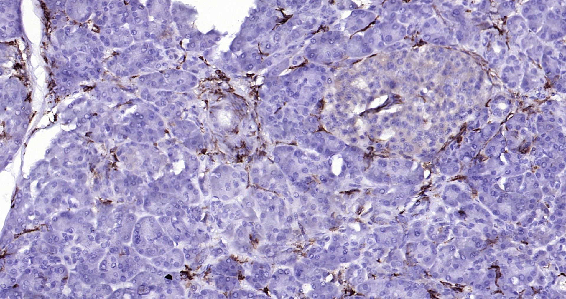 Paraformaldehyde-fixed, paraffin embedded (human pancreatic carcinoma); Antigen retrieval by boiling in sodium citrate buffer (pH6.0) for 15min; Block endogenous peroxidase by 3% hydrogen peroxide for 20 minutes; Blocking buffer (normal goat serum) at 37°C for 30min; Antibody incubation with (CD14) Polyclonal Antibody, Unconjugated (bs-1192R) at 1:200 overnight at 4°C, followed by operating according to SP Kit(Rabbit) (sp-0023) instructionsand DAB staining. Paraformaldehyde-fixed, paraffin embedded (human pancreatic carcinoma); Antigen retrieval by boiling in sodium citrate buffer (pH6.0) for 15min; Block endogenous peroxidase by 3% hydrogen peroxide for 20 minutes; Blocking buffer (normal goat serum) at 37°C for 30min; Antibody incubation with (CD14) Polyclonal Antibody, Unconjugated (bs-1192R) at 1:200 overnight at 4°C, followed by operating according to SP Kit(Rabbit) (sp-0023) instructionsand DAB staining.