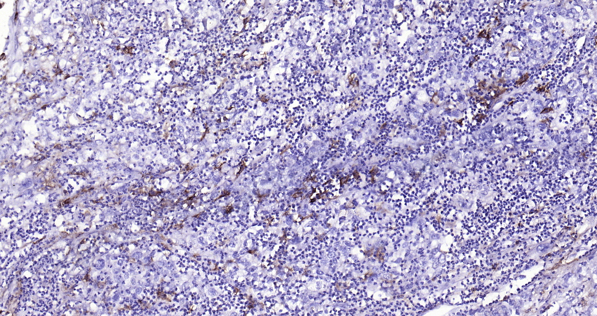 Paraformaldehyde-fixed, paraffin embedded (human endometrial carcinoma); Antigen retrieval by boiling in sodium citrate buffer (pH6.0) for 15min; Block endogenous peroxidase by 3% hydrogen peroxide for 20 minutes; Blocking buffer (normal goat serum) at 37°C for 30min; Antibody incubation with (CD14) Polyclonal Antibody, Unconjugated (bs-1192R) at 1:200 overnight at 4°C, followed by operating according to SP Kit(Rabbit) (sp-0023) instructionsand DAB staining. Paraformaldehyde-fixed, paraffin embedded (human endometrial carcinoma); Antigen retrieval by boiling in sodium citrate buffer (pH6.0) for 15min; Block endogenous peroxidase by 3% hydrogen peroxide for 20 minutes; Blocking buffer (normal goat serum) at 37°C for 30min; Antibody incubation with (CD14) Polyclonal Antibody, Unconjugated (bs-1192R) at 1:200 overnight at 4°C, followed by operating according to SP Kit(Rabbit) (sp-0023) instructionsand DAB staining.