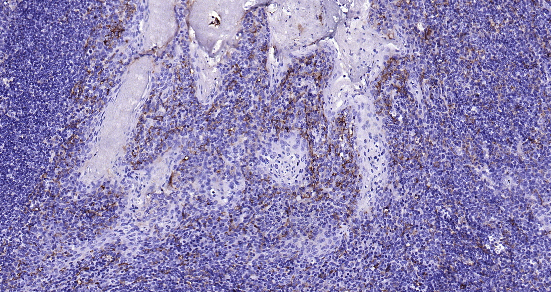 Paraformaldehyde-fixed, paraffin embedded (human tonsil); Antigen retrieval by boiling in sodium citrate buffer (pH6.0) for 15min; Block endogenous peroxidase by 3% hydrogen peroxide for 20 minutes; Blocking buffer (normal goat serum) at 37°C for 30min; Antibody incubation with (CD14) Polyclonal Antibody, Unconjugated (bs-1192R) at 1:200 overnight at 4°C, followed by operating according to SP Kit(Rabbit) (sp-0023) instructionsand DAB staining. Paraformaldehyde-fixed, paraffin embedded (human tonsil); Antigen retrieval by boiling in sodium citrate buffer (pH6.0) for 15min; Block endogenous peroxidase by 3% hydrogen peroxide for 20 minutes; Blocking buffer (normal goat serum) at 37°C for 30min; Antibody incubation with (CD14) Polyclonal Antibody, Unconjugated (bs-1192R) at 1:200 overnight at 4°C, followed by operating according to SP Kit(Rabbit) (sp-0023) instructionsand DAB staining.