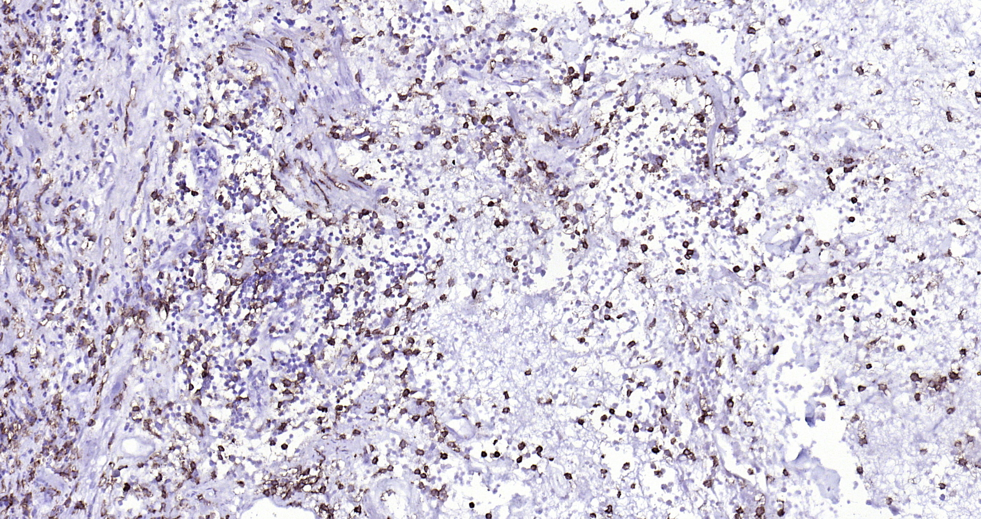 Paraformaldehyde-fixed, paraffin embedded (human appendix); Antigen retrieval by boiling in sodium citrate buffer (pH6.0) for 15min; Block endogenous peroxidase by 3% hydrogen peroxide for 20 minutes; Blocking buffer (normal goat serum) at 37°C for 30min; Antibody incubation with (CD14) Polyclonal Antibody, Unconjugated (bs-1192R) at 1:200 overnight at 4°C, followed by operating according to SP Kit(Rabbit) (sp-0023) instructionsand DAB staining. Paraformaldehyde-fixed, paraffin embedded (human appendix); Antigen retrieval by boiling in sodium citrate buffer (pH6.0) for 15min; Block endogenous peroxidase by 3% hydrogen peroxide for 20 minutes; Blocking buffer (normal goat serum) at 37°C for 30min; Antibody incubation with (CD14) Polyclonal Antibody, Unconjugated (bs-1192R) at 1:200 overnight at 4°C, followed by operating according to SP Kit(Rabbit) (sp-0023) instructionsand DAB staining.