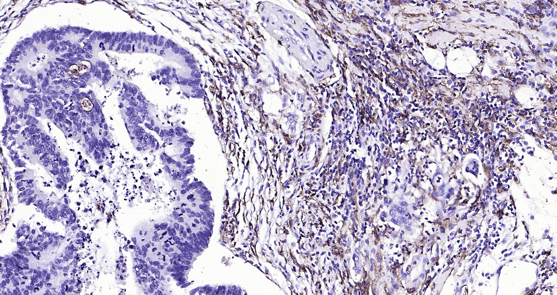 Paraformaldehyde-fixed, paraffin embedded (human colon carcinoma); Antigen retrieval by boiling in sodium citrate buffer (pH6.0) for 15min; Block endogenous peroxidase by 3% hydrogen peroxide for 20 minutes; Blocking buffer (normal goat serum) at 37°C for 30min; Antibody incubation with (CD14) Polyclonal Antibody, Unconjugated (bs-1192R) at 1:500 overnight at 4°C, followed by operating according to SP Kit(Rabbit) (sp-0023) instructionsand DAB staining. Paraformaldehyde-fixed, paraffin embedded (human colon carcinoma); Antigen retrieval by boiling in sodium citrate buffer (pH6.0) for 15min; Block endogenous peroxidase by 3% hydrogen peroxide for 20 minutes; Blocking buffer (normal goat serum) at 37°C for 30min; Antibody incubation with (CD14) Polyclonal Antibody, Unconjugated (bs-1192R) at 1:500 overnight at 4°C, followed by operating according to SP Kit(Rabbit) (sp-0023) instructionsand DAB staining.