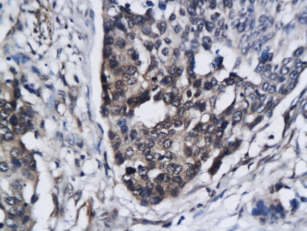 Formalin-fixed and paraffin embedded  human breast carcinoma labeled with Anti-CCR5\/CD195 Polyclonal Antibody, Unconjugated (bs-2514R) followed by conjugation to the secondary antibody