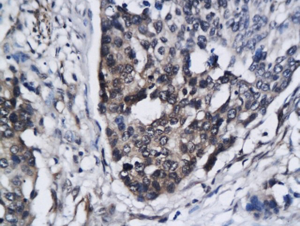 Formalin-fixed and paraffin embedded human breast carcinoma labeled with Anti-CCR5/CD195 Polyclonal Antibody, Unconjugated (bs-2514R) followed by conjugation to the secondary antibody