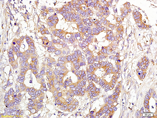 Formalin-fixed and paraffin embedded  human colon cancer  labeled with Anti-CD151\/MER2\/PETA-3 Polyclonal Antibody, Unconjugated (bs-2524R) at 1:200 followed by conjugation to the secondary antibody