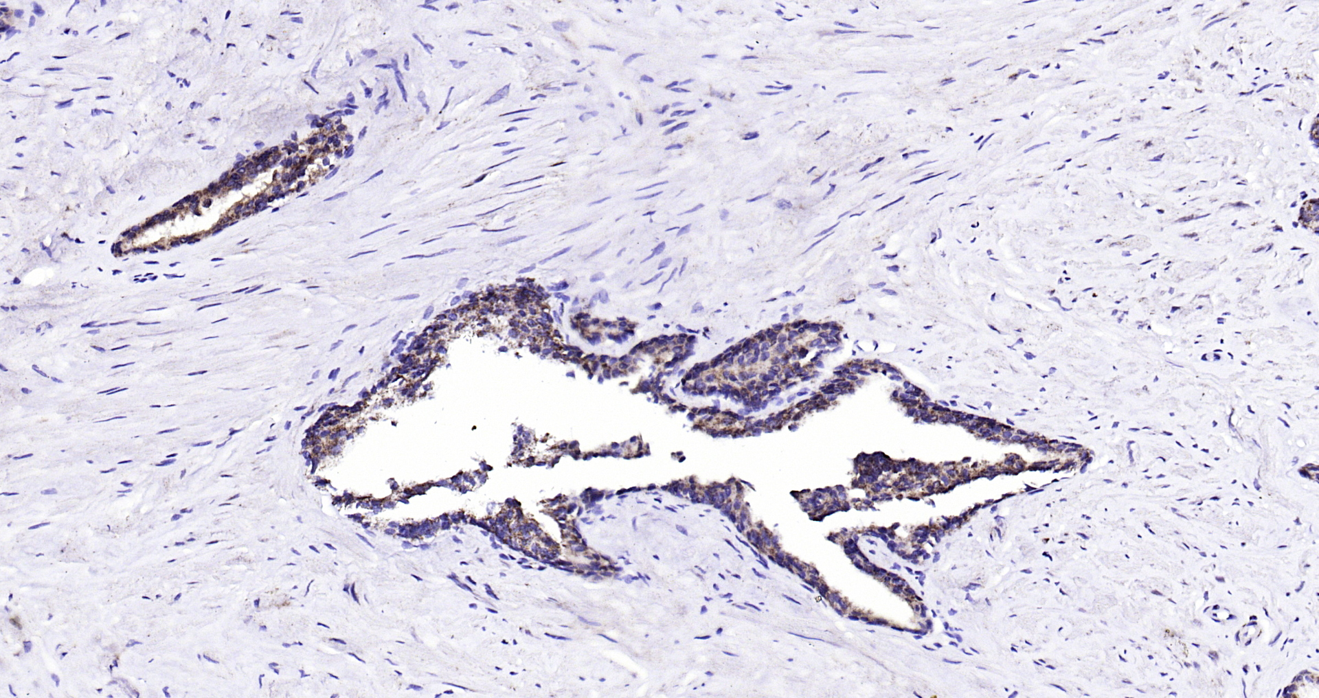 Paraformaldehyde-fixed, paraffin embedded (human prostate ); Antigen retrieval by boiling in sodium citrate buffer (pH6.0) for 15min; Block endogenous peroxidase by 3% hydrogen peroxide for 20 minutes; Blocking buffer (normal goat serum) at 37°C for 30min; Antibody incubation with (BMPR1A) Polyclonal Antibody, Unconjugated (bs-1509R) at 1:200 overnight at 4°C, followed by operating according to SP Kit(Rabbit) (sp-0023) instructionsand DAB staining.