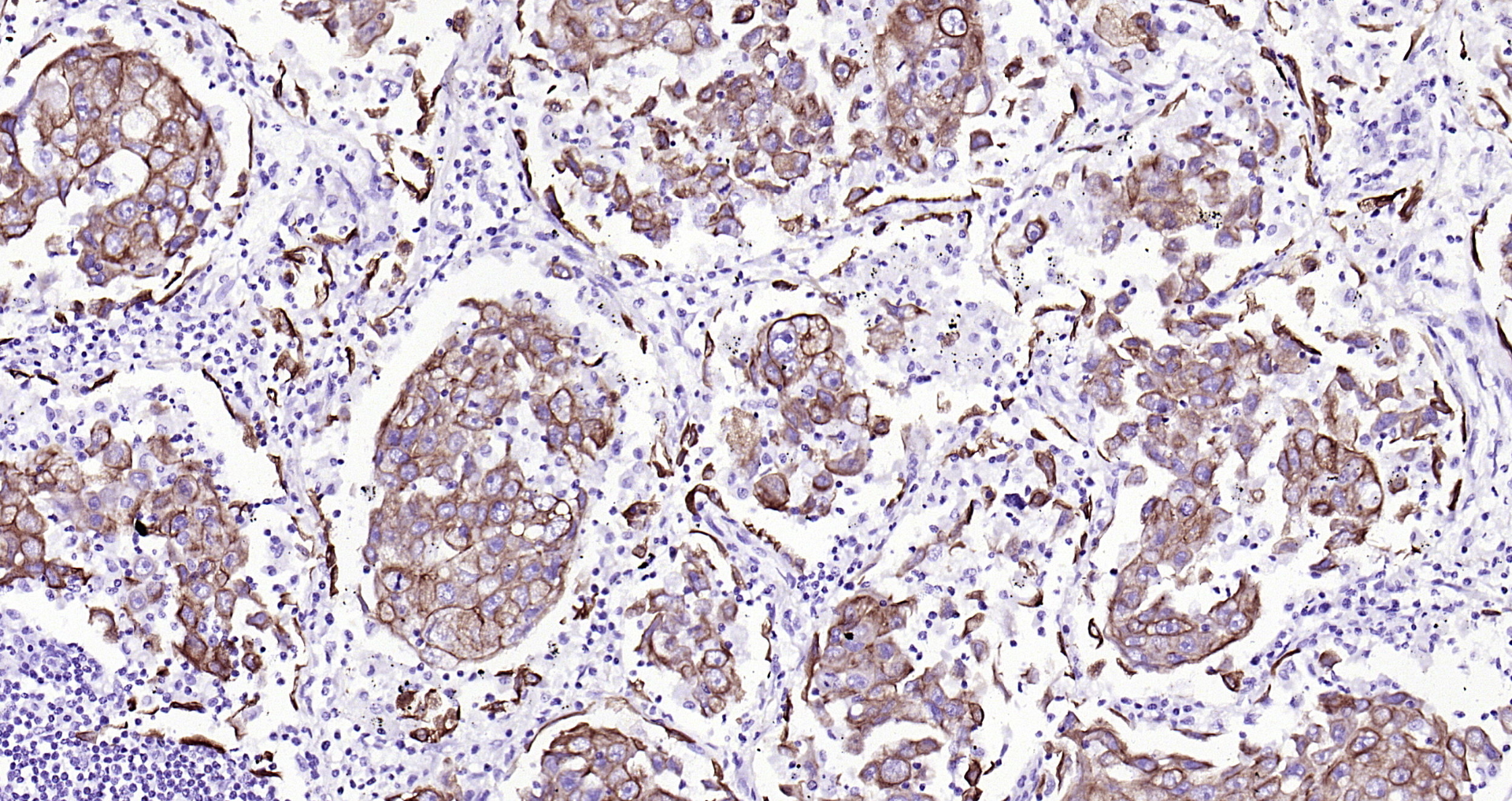 Paraformaldehyde-fixed, paraffin embedded (human lung carcinoma); Antigen retrieval by boiling in sodium citrate buffer (pH6.0) for 15min; Block endogenous peroxidase by 3% hydrogen peroxide for 20 minutes; Blocking buffer (normal goat serum) at 37°C for 30min; Antibody incubation with (CK7) Monoclonal Antibody, Unconjugated (bsm-33060M) at 1:200 overnight at 4°C, followed by operating according to SP Kit(Mouse)(sp-0024) instructionsand DAB staining.
