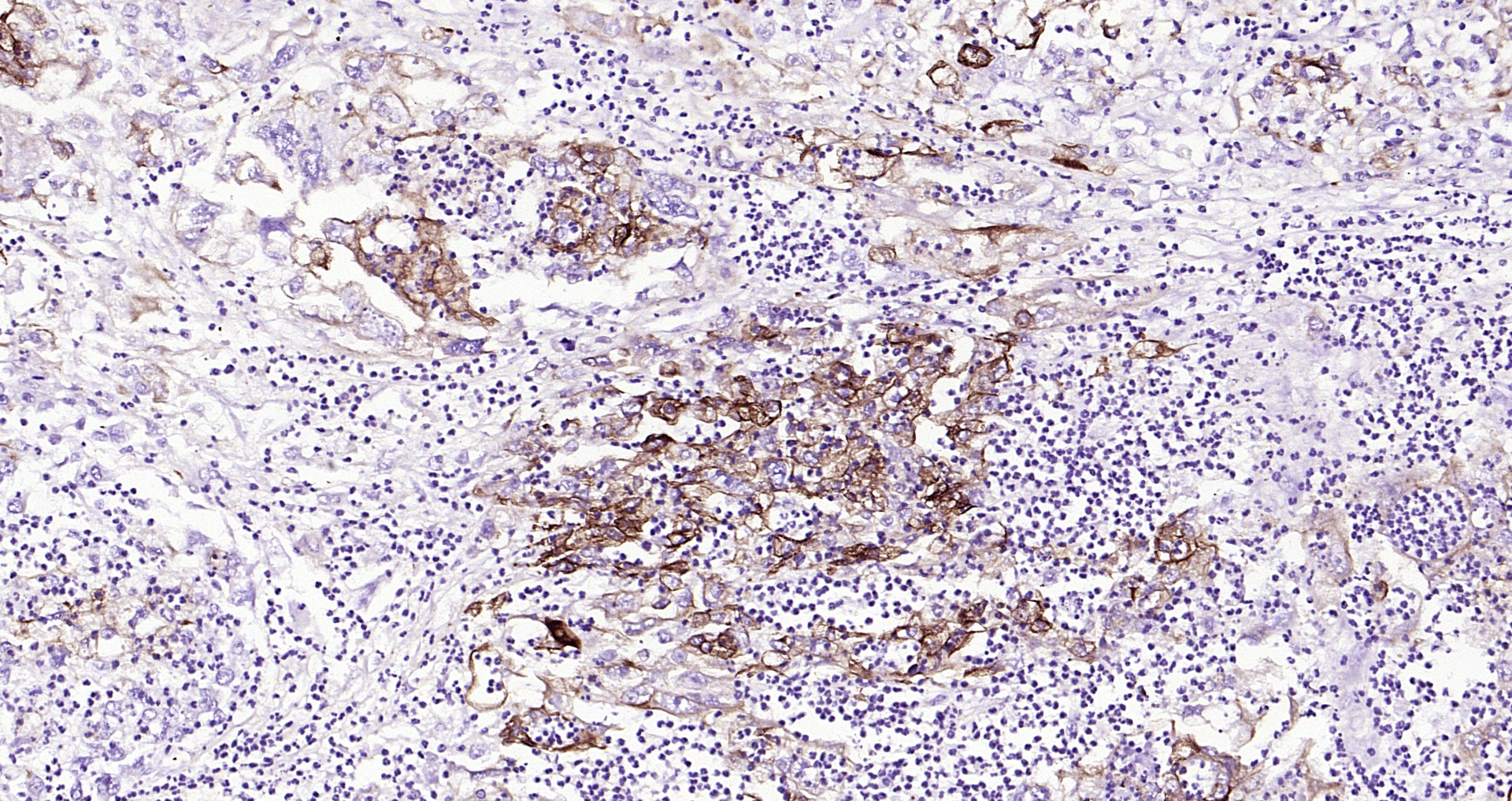 Paraformaldehyde-fixed, paraffin embedded (human Uterine Corpus Cancer); Antigen retrieval by boiling in sodium citrate buffer (pH6.0) for 15min; Block endogenous peroxidase by 3% hydrogen peroxide for 20 minutes; Blocking buffer (normal goat serum) at 37°C for 30min; Antibody incubation with (CK7) Monoclonal Antibody, Unconjugated (bsm-33060M) at 1:200 overnight at 4°C, followed by operating according to SP Kit(Mouse)(sp-0024) instructionsand DAB staining.