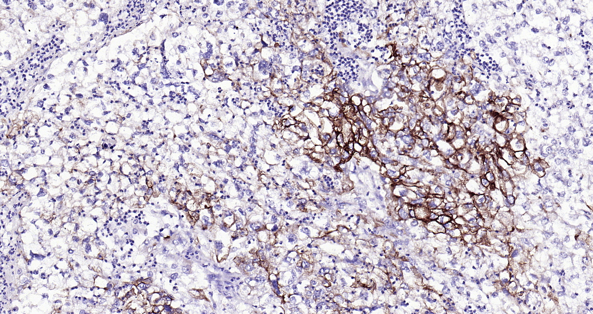 Paraformaldehyde-fixed, paraffin embedded (human Uterine Corpus Cancer); Antigen retrieval by boiling in sodium citrate buffer (pH6.0) for 15min; Block endogenous peroxidase by 3% hydrogen peroxide for 20 minutes; Blocking buffer (normal goat serum) at 37°C for 30min; Antibody incubation with (CK7) Monoclonal Antibody, Unconjugated (bsm-33060M) at 1:200 overnight at 4°C, followed by operating according to SP Kit(Mouse)(sp-0024) instructionsand DAB staining.