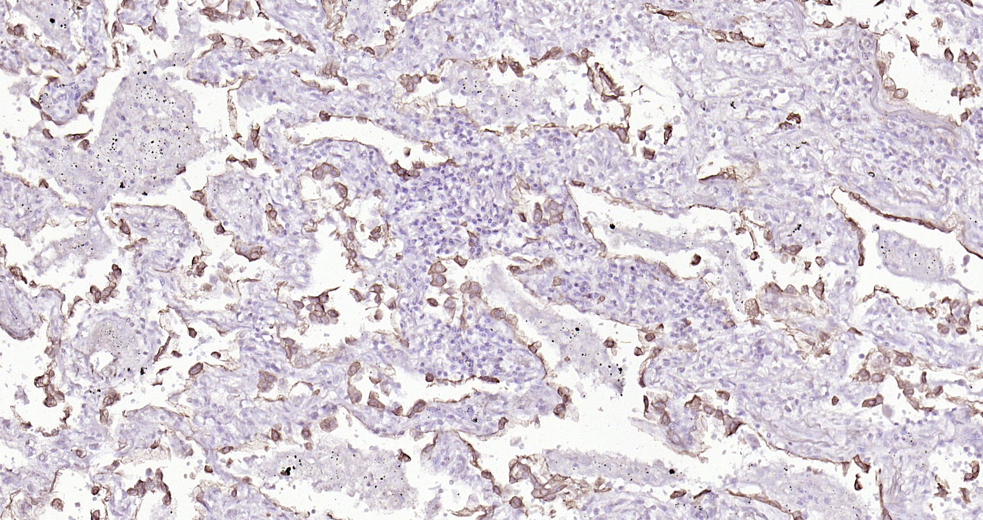 Paraformaldehyde-fixed, paraffin embedded (human lung carcinoma); Antigen retrieval by boiling in sodium citrate buffer (pH6.0) for 15min; Block endogenous peroxidase by 3% hydrogen peroxide for 20 minutes; Blocking buffer (normal goat serum) at 37°C for 30min; Antibody incubation with (Cytokeratin 8) Monoclonal Antibody, Unconjugated (bsm-33061M) at 1:200 overnight at 4°C, followed by operating according to SP Kit(Mouse)(sp-0024) instructionsand DAB staining.