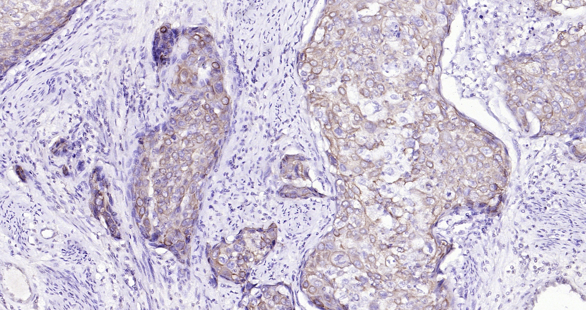 Paraformaldehyde-fixed, paraffin embedded (human cervical carcinoma); Antigen retrieval by boiling in sodium citrate buffer (pH6.0) for 15min; Block endogenous peroxidase by 3% hydrogen peroxide for 20 minutes; Blocking buffer (normal goat serum) at 37°C for 30min; Antibody incubation with (Cytokeratin 8) Monoclonal Antibody, Unconjugated (bsm-33061M) at 1:200 overnight at 4°C, followed by operating according to SP Kit(Mouse)(sp-0024) instructionsand DAB staining.
