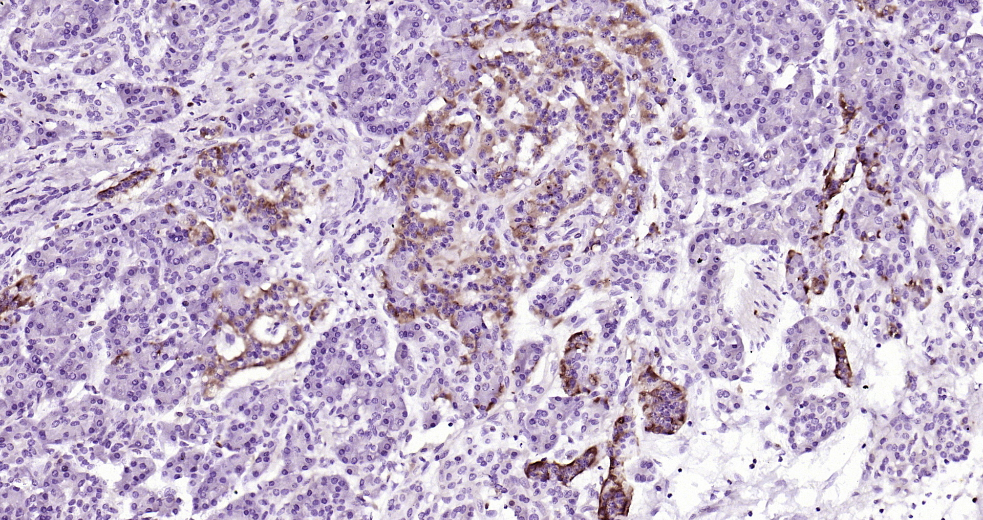 Paraformaldehyde-fixed, paraffin embedded (human pancreatic cancer); Antigen retrieval by boiling in sodium citrate buffer (pH6.0) for 15min; Block endogenous peroxidase by 3% hydrogen peroxide for 20 minutes; Blocking buffer (normal goat serum) at 37°C for 30min; Antibody incubation with (Neuropilin-1(49H9) ) Monoclonal Antibody, Unconjugated (bsm-52479R) at 1:200 overnight at 4°C, followed by operating according to SP Kit(Rabbit) (sp-0023) instructionsand DAB staining.
