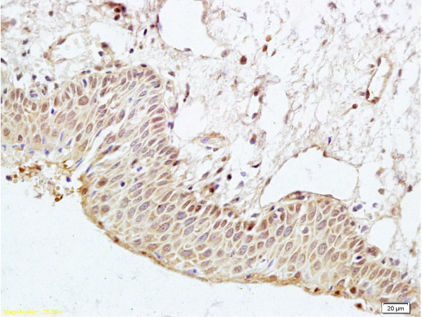 Formalin-fixed and paraffin embedded human cervical cancer labeled with Anti-PAR3 Polyclonal Antibody, Unconjugated (bs-2921R) at 1:200 followed by conjugation to the secondary antibody and DAB staining