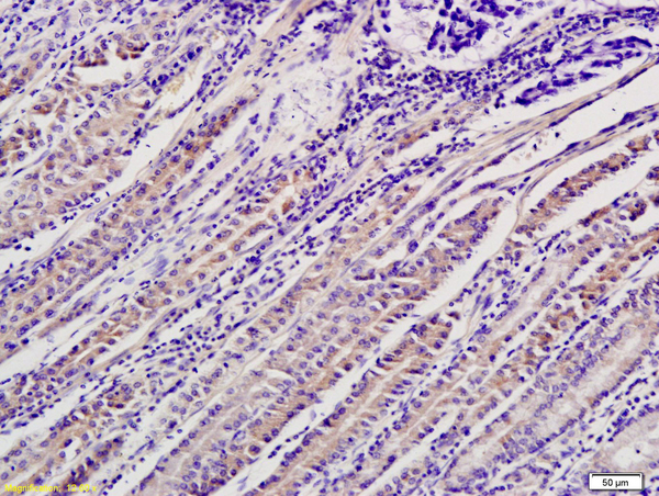 Formalin-fixed and paraffin embedded human gastric cancer labeled with Anti-ADM2 Polyclonal Antibody, Unconjugated (bs-2985R) followed by conjugation to the secondary antibody and DAB staining