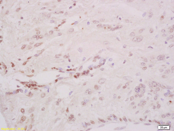 Formalin-fixed and paraffin embedded human cervical carcinoma labeled with Anti-Phospho-CHK2 (Thr68) Polyclonal Antibody, Unconjugated (bs-3721R) at 1:200 followed by conjugation to the secondary antibody and DAB staining\\n