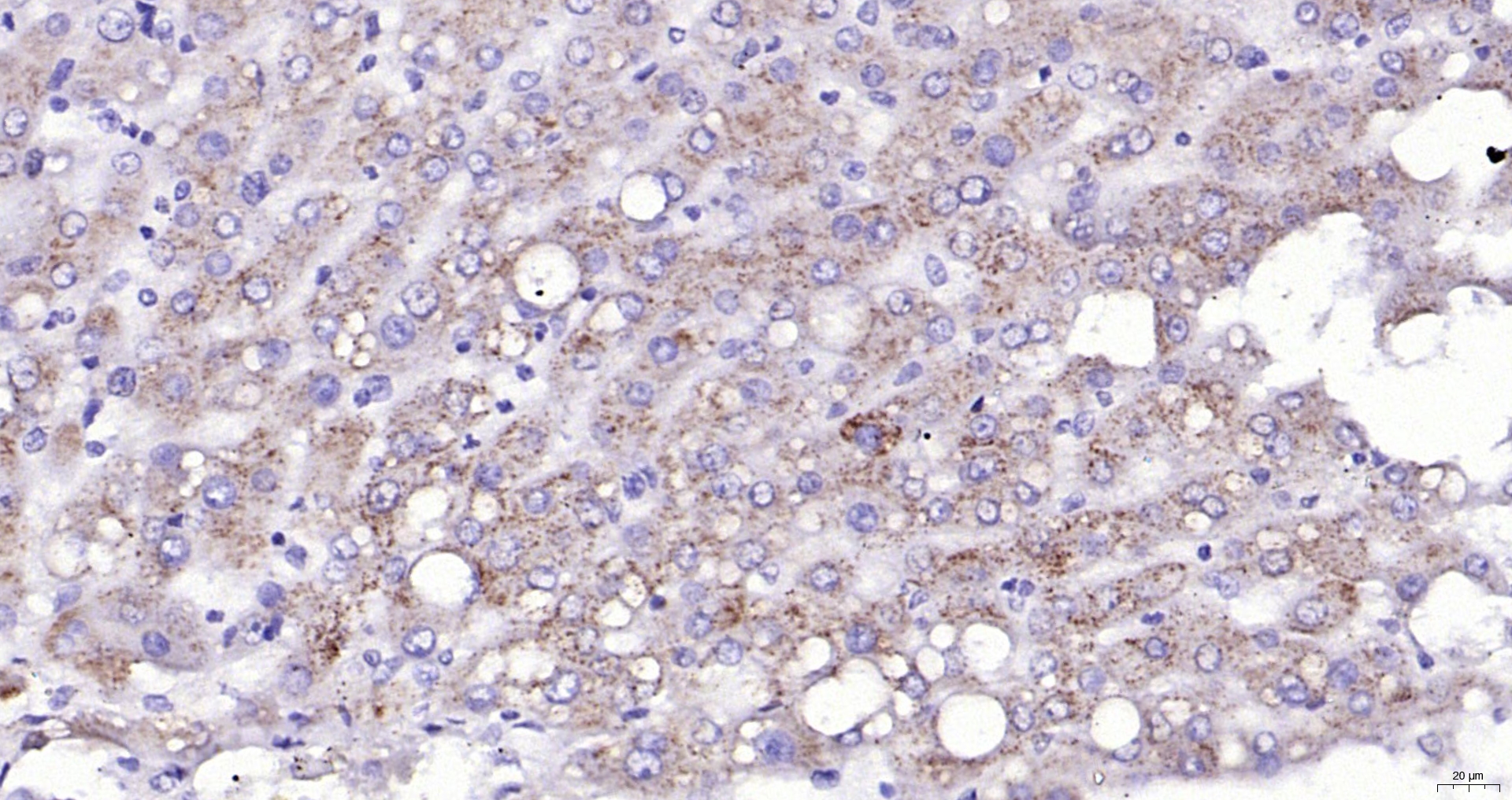 Paraformaldehyde-fixed, paraffin embedded (human liver); Antigen retrieval by boiling in sodium citrate buffer (pH6.0) for 15min; Block endogenous peroxidase by 3% hydrogen peroxide for 20 minutes; Blocking buffer (normal goat serum) at 37°C for 30min; Antibody incubation with (TFRC ) Polyclonal Antibody, Unconjugated (bs-0988R) at 1:200 overnight at 4°C, followed by operating according to SP Kit(Rabbit) (sp-0023) instructionsand DAB staining.