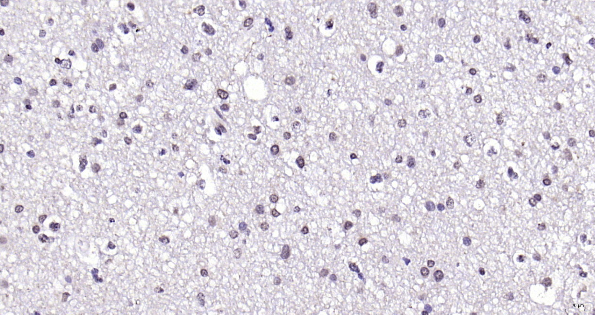 Paraformaldehyde-fixed, paraffin embedded (human brain glioma); Antigen retrieval by boiling in sodium citrate buffer (pH6.0) for 15min; Block endogenous peroxidase by 3% hydrogen peroxide for 20 minutes; Blocking buffer (normal goat serum) at 37°C for 30min; Antibody incubation with (KAT4) Polyclonal Antibody, Unconjugated (bs-2812R) at 1:200 overnight at 4°C, followed by operating according to SP Kit(Rabbit) (sp-0023) instructionsand DAB staining.