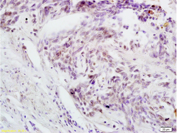 Formalin-fixed and paraffin embedded human rectal carcinoma labeled with Anti-Phospho-cdc25C (Thr48) Polyclonal Antibody, Unconjugated (bs-3482R) at 1:200 followed by conjugation to the secondary antibody and DAB