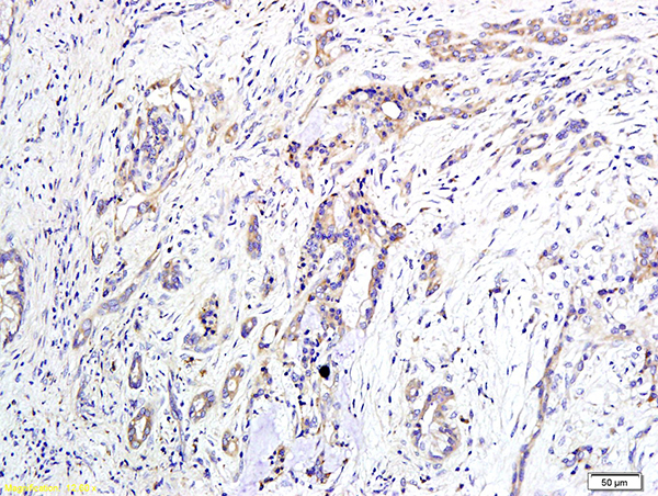 Formalin-fixed and paraffin embedded human pancreatic cancer labeled with Anti-EDG2/LPA1 Polyclonal Antibody, Unconjugated (bs-2880R) at 1:400 followed by conjugation to the secondary antibody and DAB staining