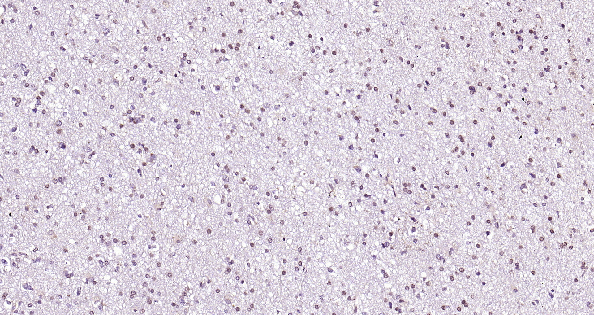 Paraformaldehyde-fixed, paraffin embedded (human brain glioma); Antigen retrieval by boiling in sodium citrate buffer (pH6.0) for 15min; Block endogenous peroxidase by 3% hydrogen peroxide for 20 minutes; Blocking buffer (normal goat serum) at 37\u00b0C for 30min; Antibody incubation with (RAR Beta) Polyclonal Antibody, Unconjugated (bs-0516R) at 1:200 overnight at 4\u00b0C, followed by operating according to SP Kit(Rabbit) (sp-0023) instructionsand DAB staining.