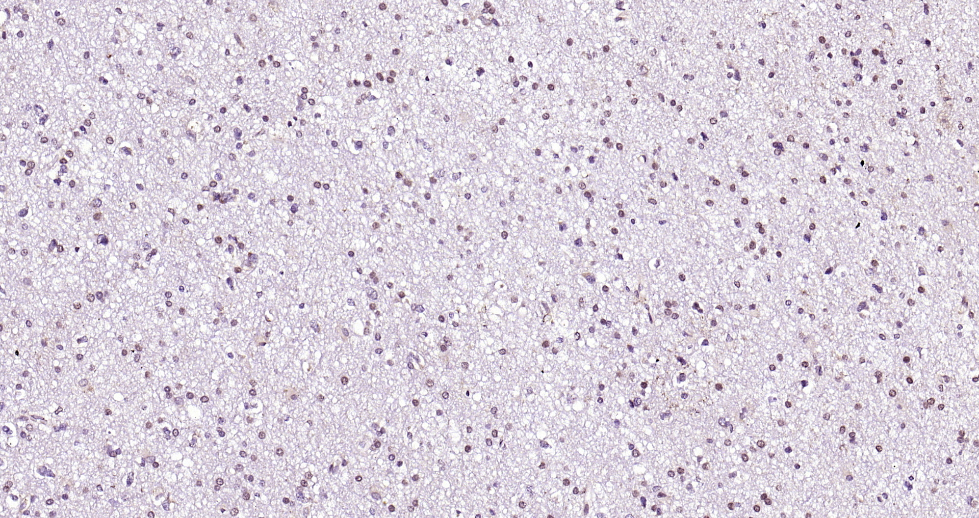 Paraformaldehyde-fixed, paraffin embedded (human brain glioma); Antigen retrieval by boiling in sodium citrate buffer (pH6.0) for 15min; Block endogenous peroxidase by 3% hydrogen peroxide for 20 minutes; Blocking buffer (normal goat serum) at 37°C for 30min; Antibody incubation with (RAR Beta) Polyclonal Antibody, Unconjugated (bs-0516R) at 1:200 overnight at 4°C, followed by operating according to SP Kit(Rabbit) (sp-0023) instructionsand DAB staining.