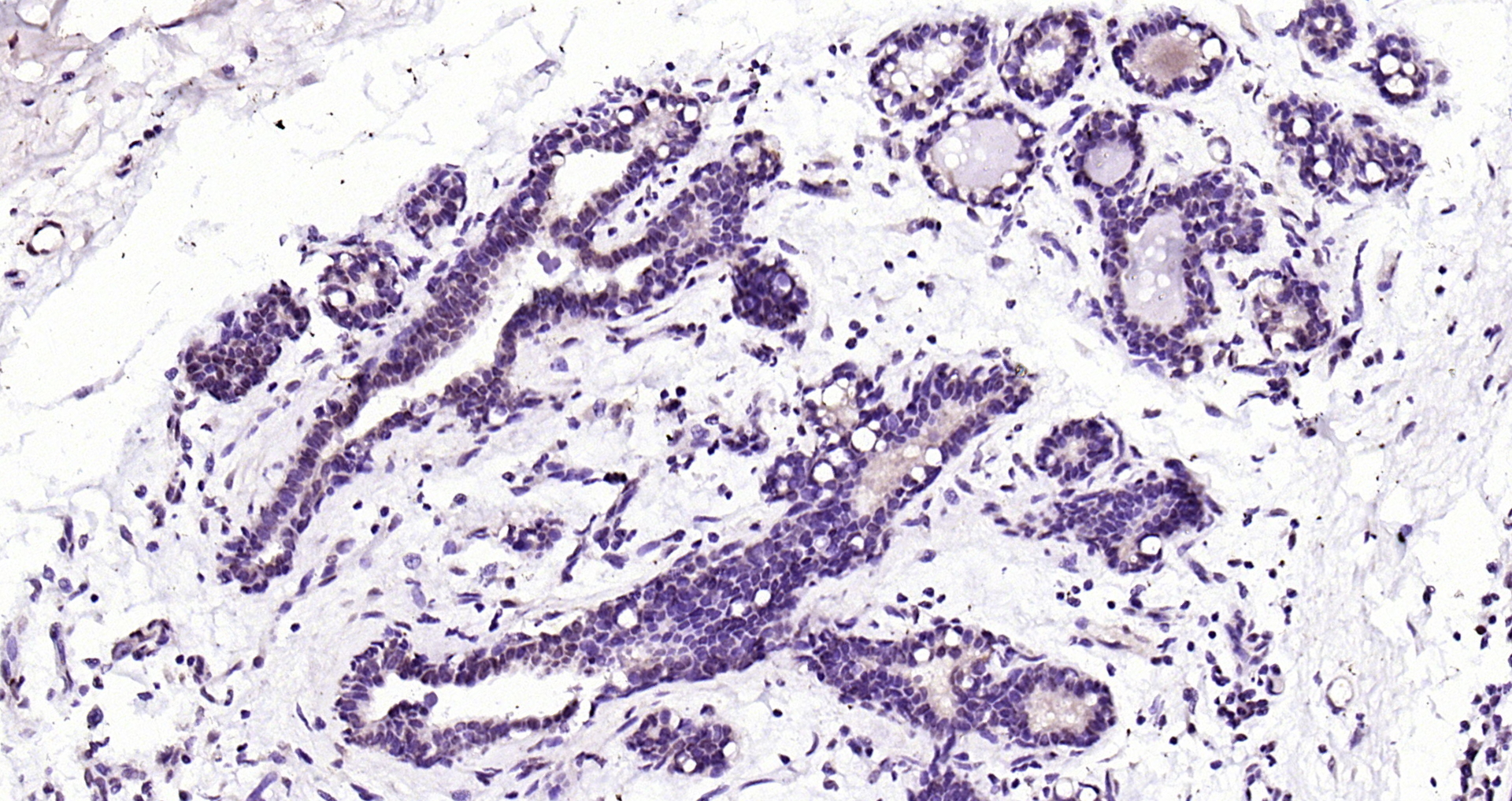 Paraformaldehyde-fixed, paraffin embedded (human breast); Antigen retrieval by boiling in sodium citrate buffer (pH6.0) for 15min; Block endogenous peroxidase by 3% hydrogen peroxide for 20 minutes; Blocking buffer (normal goat serum) at 37°C for 30min; Antibody incubation with (RAR Beta) Polyclonal Antibody, Unconjugated (bs-0516R) at 1:200 overnight at 4°C, followed by operating according to SP Kit(Rabbit) (sp-0023) instructionsand DAB staining.