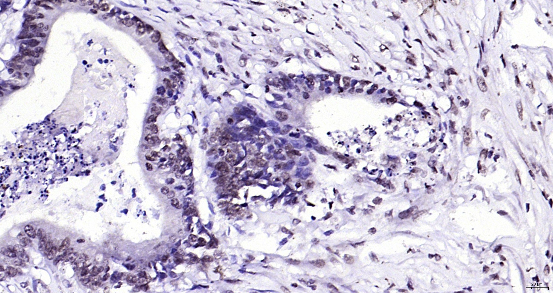 Paraformaldehyde-fixed, paraffin embedded (human colon carcinoma); Antigen retrieval by boiling in sodium citrate buffer (pH6.0) for 15min; Block endogenous peroxidase by 3% hydrogen peroxide for 20 minutes; Blocking buffer (normal goat serum) at 37°C for 30min; Antibody incubation with (Phospho-FGFR1 (Tyr307)) Polyclonal Antibody, Unconjugated (bs-5325R) at 1:200 overnight at 4°C, followed by operating according to SP Kit(Rabbit) (sp-0023) instructionsand DAB staining.