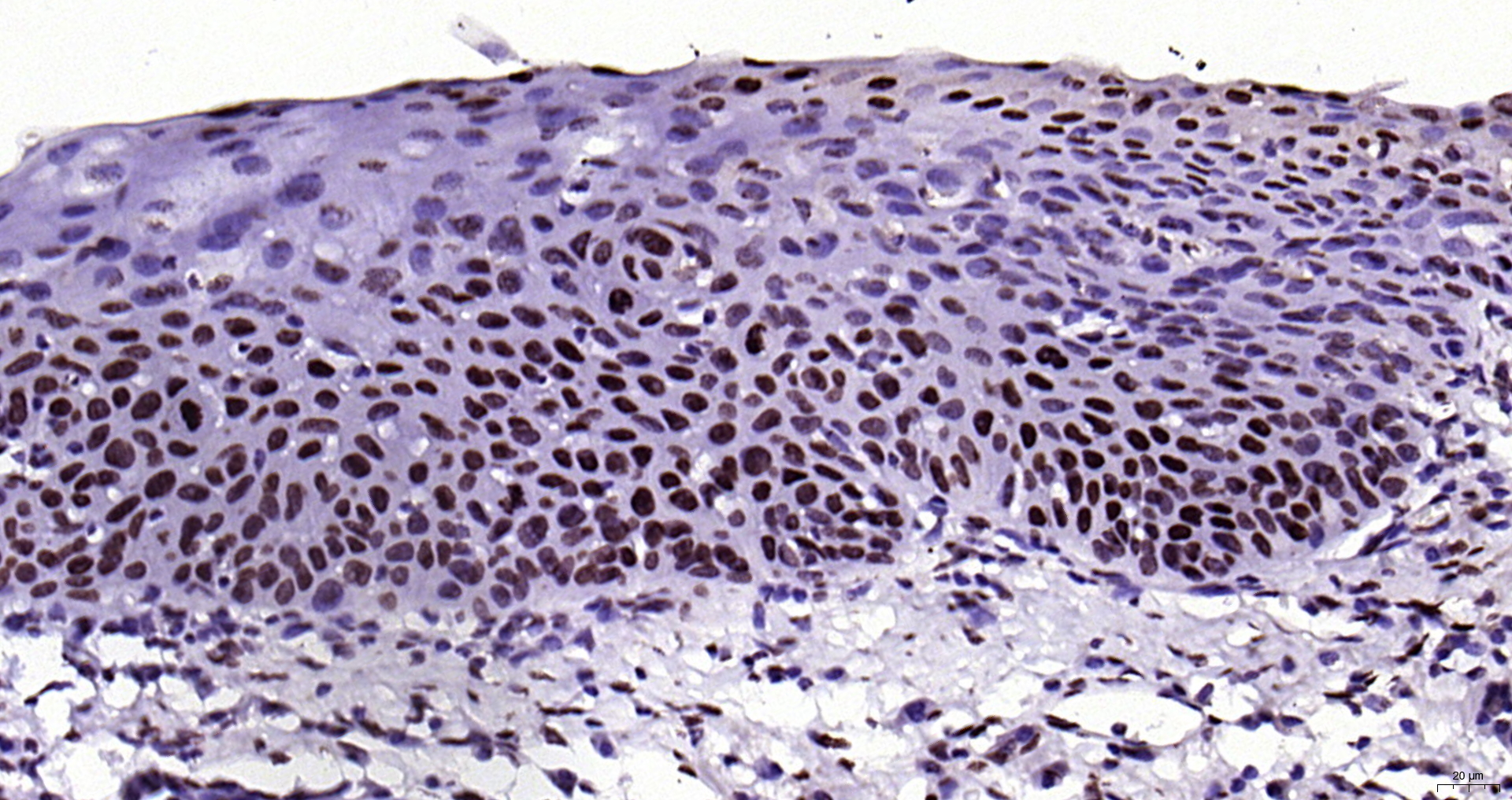Paraformaldehyde-fixed, paraffin embedded (human laryngeal carcinoma); Antigen retrieval by boiling in sodium citrate buffer (pH6.0) for 15min; Block endogenous peroxidase by 3% hydrogen peroxide for 20 minutes; Blocking buffer (normal goat serum) at 37°C for 30min; Antibody incubation with (Phospho-FGFR1 (Tyr307)) Polyclonal Antibody, Unconjugated (bs-5325R) at 1:200 overnight at 4°C, followed by operating according to SP Kit(Rabbit) (sp-0023) instructionsand DAB staining.