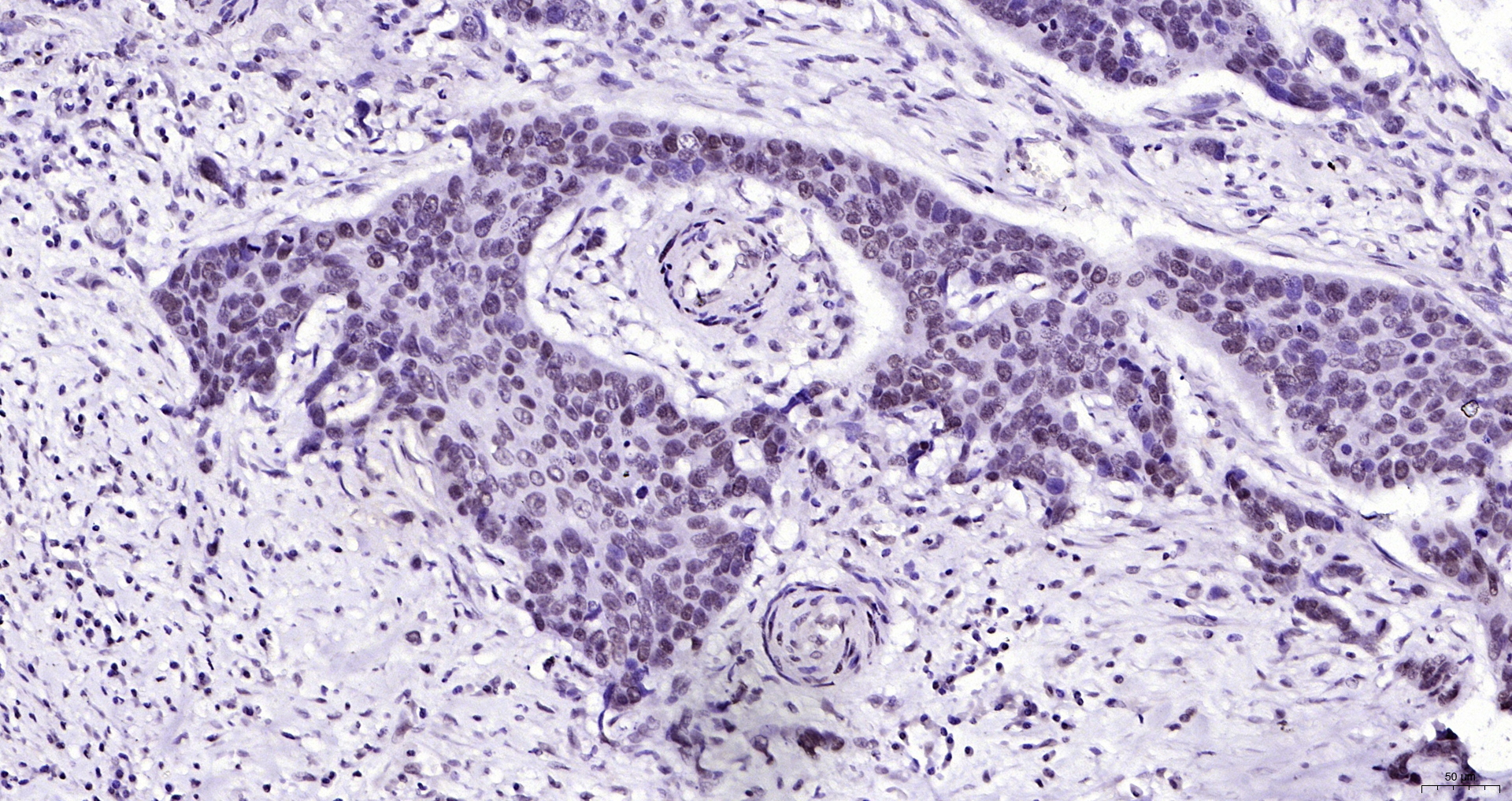 Paraformaldehyde-fixed, paraffin embedded (human esophageal cancer); Antigen retrieval by boiling in sodium citrate buffer (pH6.0) for 15min; Block endogenous peroxidase by 3% hydrogen peroxide for 20 minutes; Blocking buffer (normal goat serum) at 37°C for 30min; Antibody incubation with (Phospho-FGFR1 (Tyr307)) Polyclonal Antibody, Unconjugated (bs-5325R) at 1:200 overnight at 4°C, followed by operating according to SP Kit(Rabbit) (sp-0023) instructionsand DAB staining.